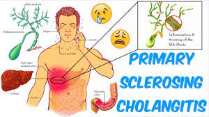 Maybe you would like to learn more about one of these? Primary Sclerosing Cholangitis Psc Youtube