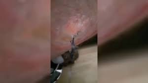 Maybe you would like to learn more about one of these? Download The Longest Grossest Ingrown Hair In History Mp4 Mp3 3gp Naijagreenmovies Fzmovies Netnaija