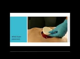How To Install The Npwt Black Foam Dressing Kit On A Wound Dress Kit Dressing Foam