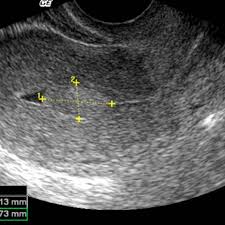 Check spelling or type a new query. Usefulness Of Endovaginal Ultrasound In The Diagnosis Of A Premenopausal Women With Abnormal Vaginal Bleeding Eurorad