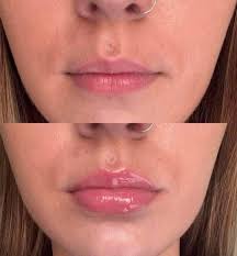 Lip plumper balm for soft, moisturized lips