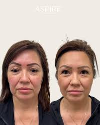 Proof that lift doesn't always require downtime. ✨ This before and after  shows the powerful results of PDO threads—a non-surgical treatment that  subtly repositions and lifts the skin while encouraging collagen production.