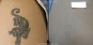 Sometimes you've just got to get tattooed, you know what i mean? Tattoo Removal Service New York Nyc Laser Skin Center