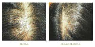 Derma roller for hair loss: Meso Hair Micro Needling Singapore Papilla Haircare