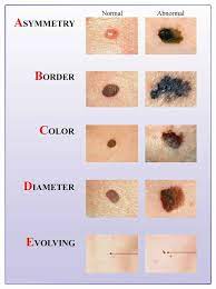 Melanoma is a type of skin cancer that develops in the skin cells (melanocytes) responsible for producing the pigment that gives your skin color (melanin). Msk Nhs Ayrshire Arran Cases Of Skin Cancer In Scotland Have Increased By More Than 30 In The Past Decade According To Latest Nhs Figures Regular Skin Check Early