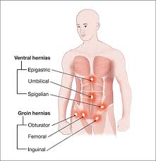 It extends up from there to the hip. Diagram Of Male Groin Area Hesselbach Triangle What Is It Location And More Osmosis Gianna Daily Update