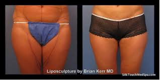 Is Smartlipo And Or Vaser For Inner Thighs The Way To Shaplier Legs