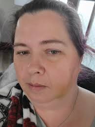 What can I do at home to help my eye issue?