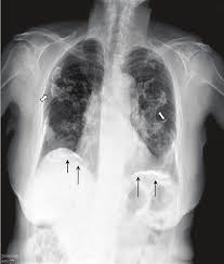 Malignant pleural mesothelioma (mpm) is an uncommon neoplasm. A Posteroanterior And B Lateral Chest Films Showed Extensive Download Scientific Diagram