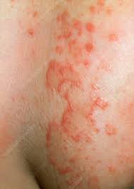 Image result for Candidiasis under breasts