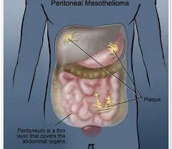 Glioblastoma is an aggressive cancer of the brain. Pin On Malignant Mesothelioma