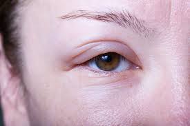 Image result for Angioedema