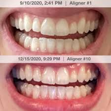 Aligners Can For Your Cants | Orthodontic Products
