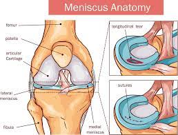 Without treatment, a piece of a torn meniscus can result from any activity that causes you to forcefully twist or rotate your knee, such as aggressive pivoting or sudden stops and turns. Nfl Week 14 Injury Report How A Torn Meniscus Can Change Your Life Health News Hub