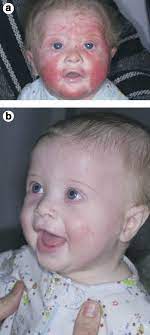 A Infant With Severe Atopic Dermatitis B Same Infant After 1 Week Download Scientific Diagram