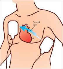 An automated external defibrillator ready for use. Defibrillation Nurse Key