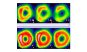 Le score calcique est un parametre representatif de la quantite de calcification se trouvant sur le reseau coronaire. Scintigraphie Myocardique Et Epreuve D Effort En Bretagne