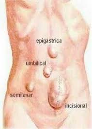 Ventral Hernia Pictures Repair Symptoms Surgery Types Abdominal Hernia Medical Transcription Hernia Repair