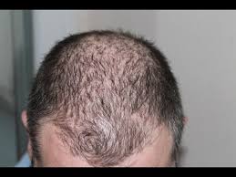 Research shows that hair loss can be caused due to less blood circulation (5). Is Tea Tree Oil Good For Hair Growth