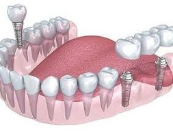 Dental Implant 02 3d Model In 2020 Dental Implants Dental Implants