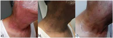 Image result for Radiation Dermatitis