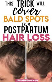 Essentially, postpartum hair loss is just hair loss that's related to childbirth, says shani francis, m.d., a dermatologist and chief wellness officer of ashira dermatology in gurnee, il. How To Quickly Cover Bald Spots During Postpartum Hair Loss Just Simply Mom