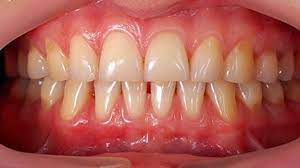 Fortunately, there are ways to reverse the effects and prevent further however, there are treatment options that can raise your gum line back up to its original position, and there are ways to stop receding gums from getting worse. Is Age The Cause Of Receding Gums Bbc Future