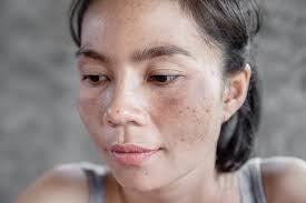 Image result for Melasma
