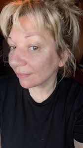 Day 20 Check-In of my Fluorouracil Cream Skin Cancer Treatment: The Peeling  Phase is REAL 😳 It's been 6 days since I stopped the fluorouracil cream,  and I thought by now my