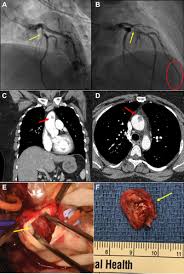 Maybe you would like to learn more about one of these? Aortic Mural Thrombus And Acute Coronary Syndrome In A Patient With Cannabinoid Hyperemesis Syndrome Jacc Case Reports