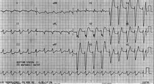 hyperkalemia practice essentials background pathophysiology