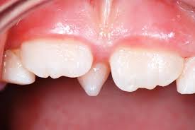 By definition, this is an extra tooth that lies between a person's central incisors (their center two teeth). Kinderzahnmedizin Dr Med Dent Lorenz Fluckiger