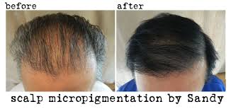Pin On Scalp Micropigmentation