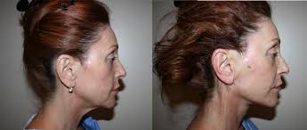 Thread lift before and after uk. Face Lift Without Surgery Silhouette Lift Threadlift London Birmingham