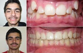 In addition to dental correction, braces can also achieve a degree of skeletal realignment when paired with elastics, expanders and other appliances. Can Invisalign Fix Overbites And Other Bite Problems Premier Orthodontics