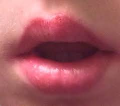 Sicher ist, dass aphten in einigen familien häufiger auftreten als in anderen. Was Ist Das Ein Blaschen Auf Der Lippe Pickel Herpes Infektion