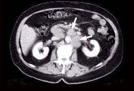 When malignant cancer cells form and grow within a person's breast tissue, breast cancer occurs. Prostate Cancer Diagnosis And Staging