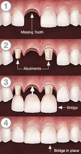 32 Dental Bridges Ideas Dental Bridge Dental Dental Crowns
