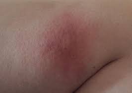 Nakoniec mi na konci prveho trimestra bola diagnostikovana borelioza. Reakcia Po Kliestovi Modry Konik