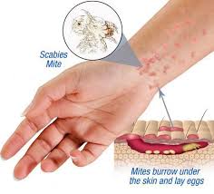 Image result for scabies human bites