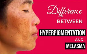 Image result for Melasma