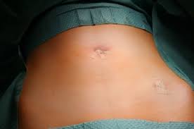 Leider hab ich heute meine tage bekommen. Appendicitis