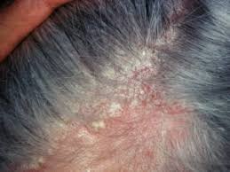 Image result for sores on the head in children