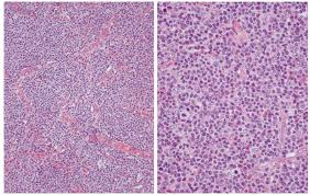 It is one of the. Angioimmunoblastic T Cell Lymphoma An Epstein Barr Virus Associated Bilineage Lymphoid Neoplasm Asian Archives Of Pathology