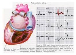 Infarctul miocardic acut referat,referat infarctul miocardic acut,infarctul miocardic,parametrii stresului oxidativ la pacientii cu infarct miocardic,infarct de. Lucrare De Diploma Asistenta Medicala Ingrijiri Speciale Acordate Pacientului Cu Infarct Miocardic Acut