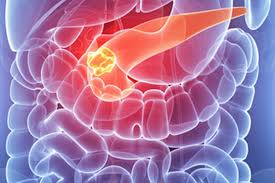 If you are experiencing one or more of these symptoms, speak to your doctor immediately and reference pancreatic cancer. Pancreatic Cancer Pancreas Cancer Signs Diagnosis Treatment In Singapore Pcc Singapore