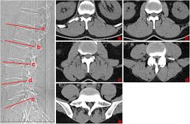The deltoid, teres major, teres minor, infraspinatus, supraspinatus (not shown) and subscapularis muscles (not shown) all extend from the scapula to the humerus and act on the shoulder joint. Ct And Mri Determination Of Intermuscular Space Within Lumbar Paraspinal Muscles At Different Intervertebral Disc Levels