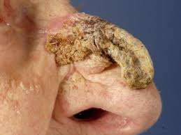 Image result for cornu cutaneum)