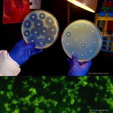Listeria monocytogenes causes, signs and symptoms, outbreak, prevention, and treatment. Listeria Symptoms
