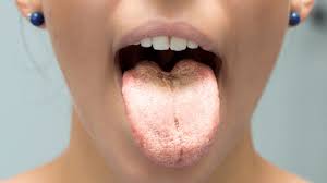 Image result for Fissured tongue